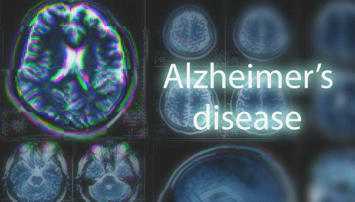 10 Early Signs of Alzheimer&#8217;s Disease