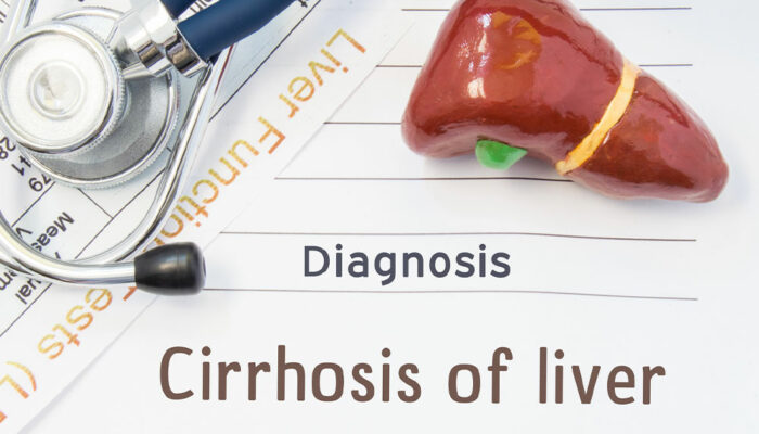 Liver Cirrhosis &#8211; Its Stages and Prevention