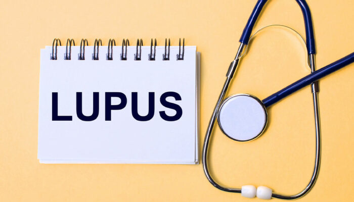 Lupus &#8211; Signs, Causes and Types