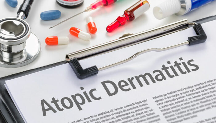 Measures to Manage and Prevent Atopic Dermatitis