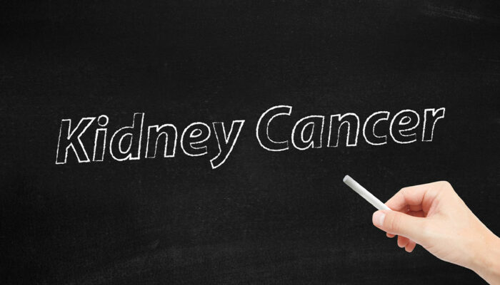 The Symptoms and Stages of Kidney Cancer