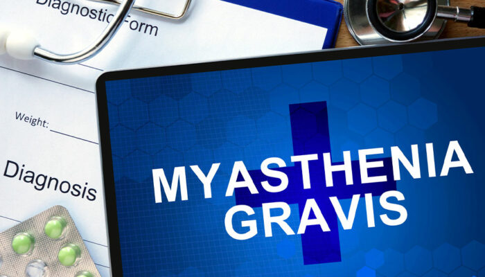 Top Therapies for Those With Myasthenia Gravis