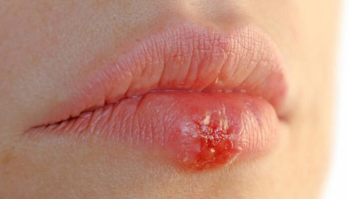 4 effective home remedies for herpes