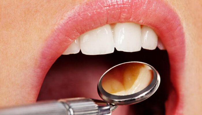 4 myths about dental implants busted