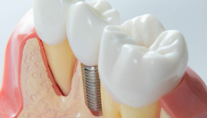 4 practical tips to maintain dental implants for seniors