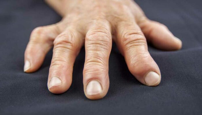 5 Causes of Swollen Fingers