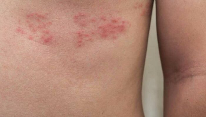 5 Ways to Deal with Shingles Nerve Pain