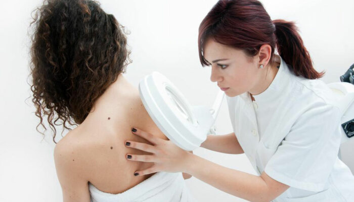 5 ways to reduce the risk of melanoma