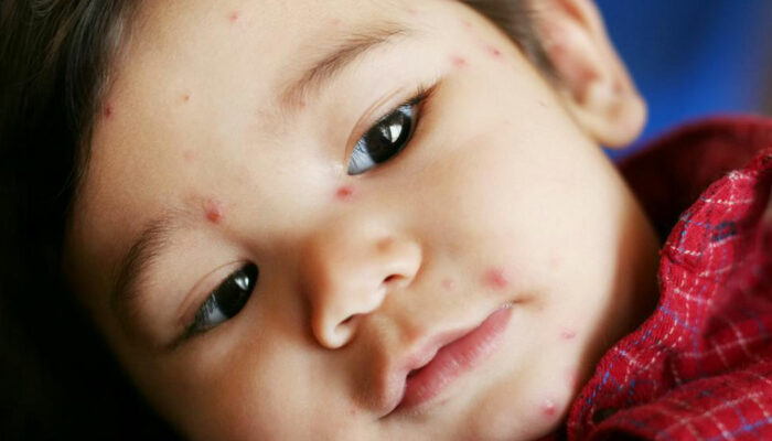 5 tell-tale signs of chickenpox you should know about