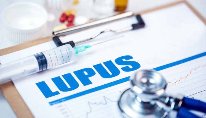 5 things to know about Lupus