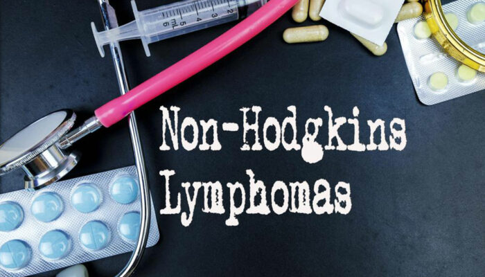 6 common risk factors for Non-Hodgkin lymphoma