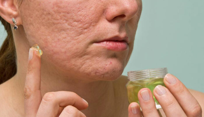 6 useful tips to treat acne scars, marks, and blemishes