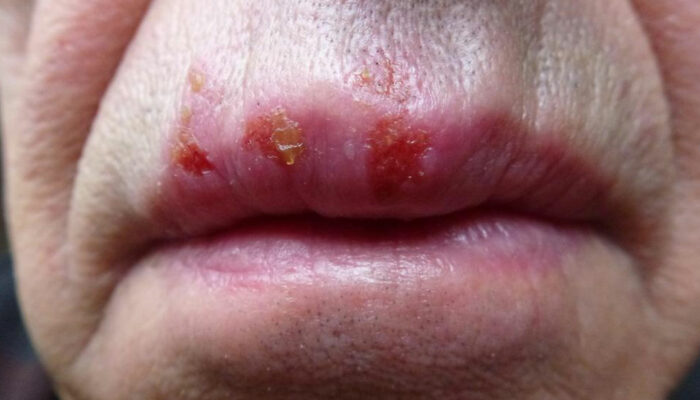 7 myths about herpes