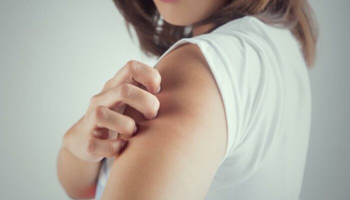 10 Reasons Why You Get Hives