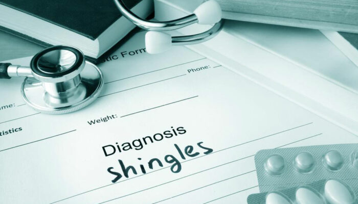 A compact guide to understanding shingles- Causes, symptoms, and treatments