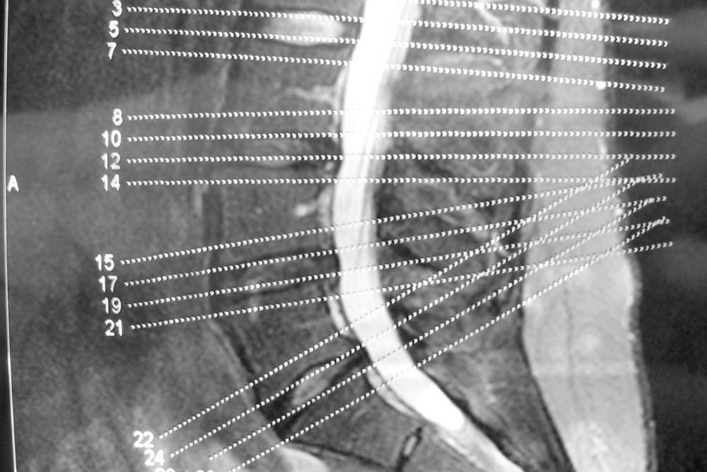 A brief overview of degenerative disc and joint disease