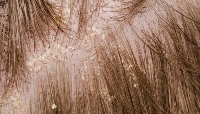 A brief overview of scalp psoriasis