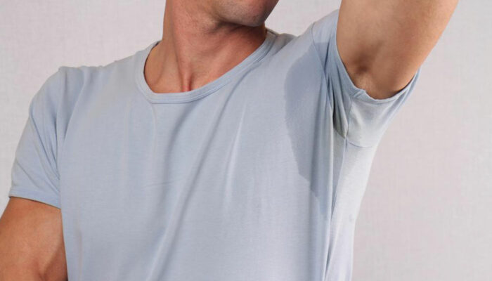 Advanced management of excessive sweating