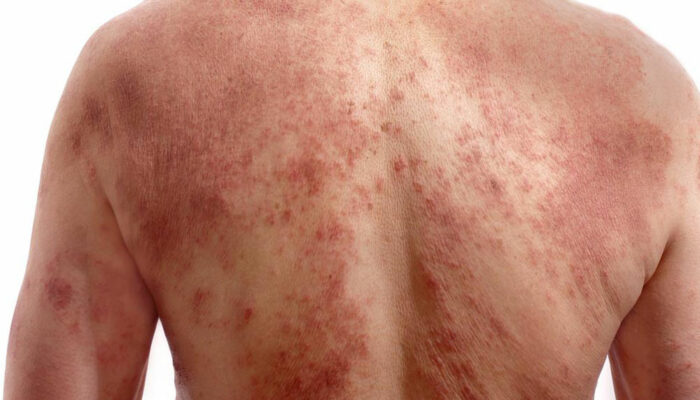 A few quick ways to identify chickenpox infection