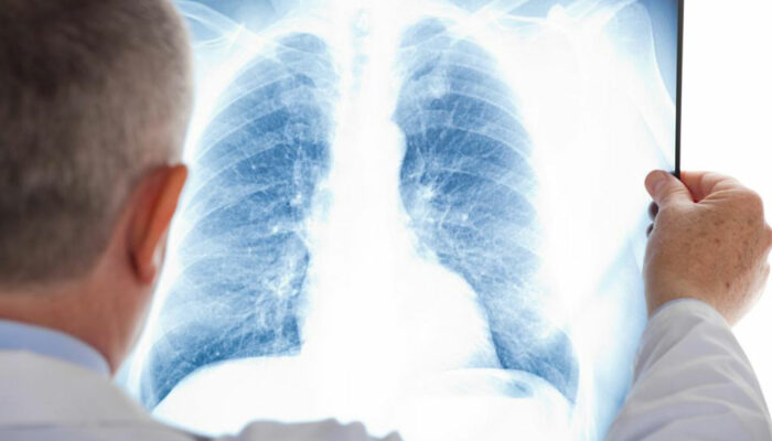 A few things you should know about mesothelioma cancer