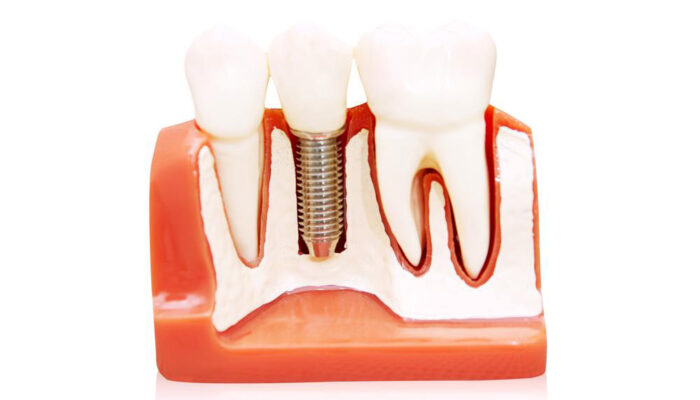 All you need to know about permanent dentures