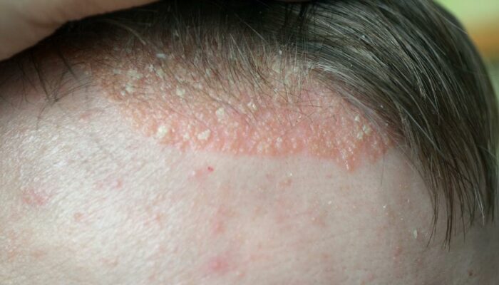 All you need to know about scalp psoriasis