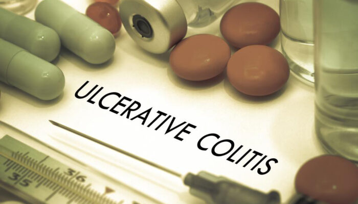 An overview for the treatment of Ulcerative Colitis