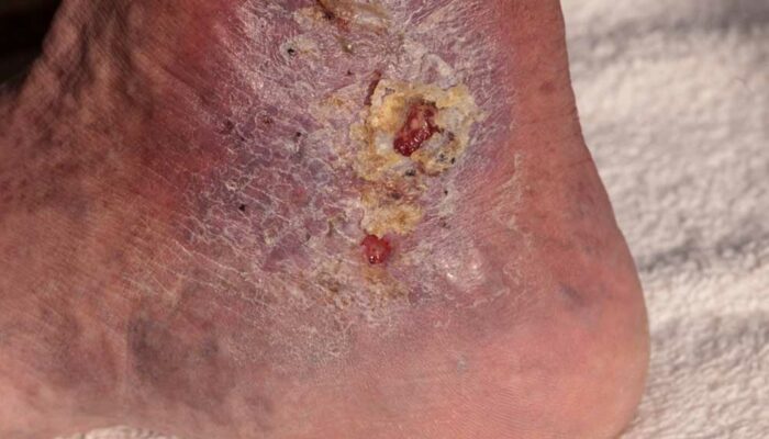 Causes and Symptoms of Cellulitis