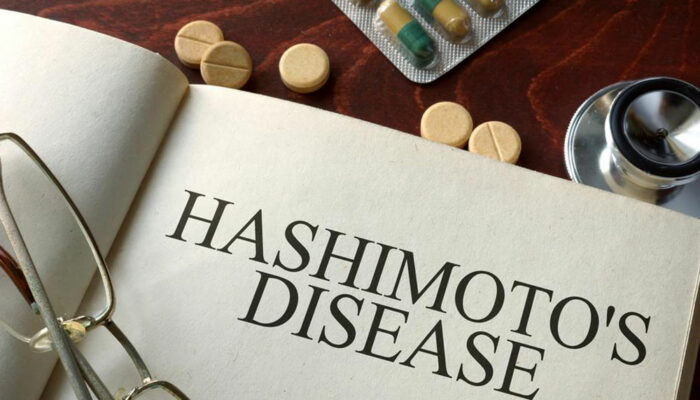 Causes and symptoms of hashimotos disease