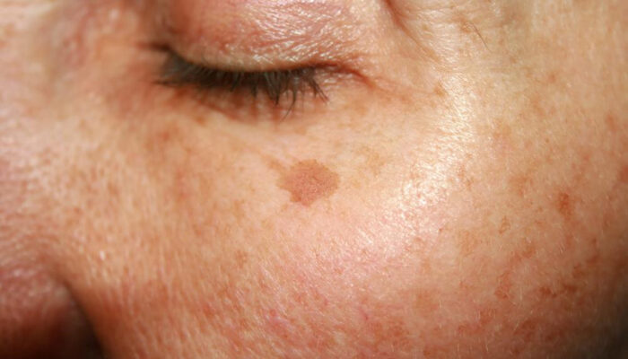 Cheap, effective remedies lighten age spots naturally