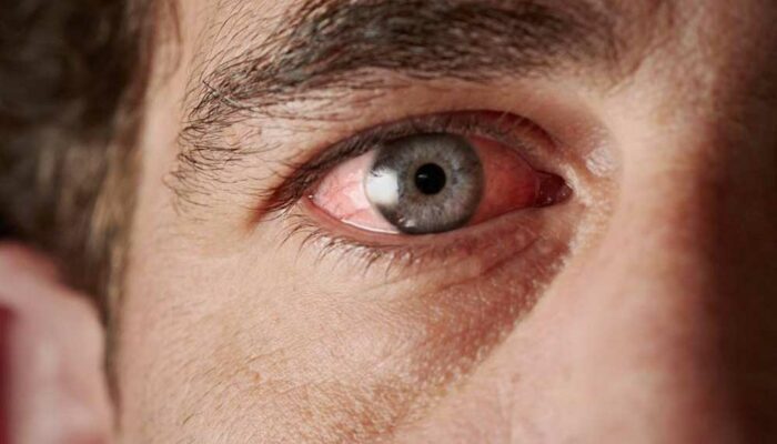 Common Causes of Blood Vessel Burst in the Eye