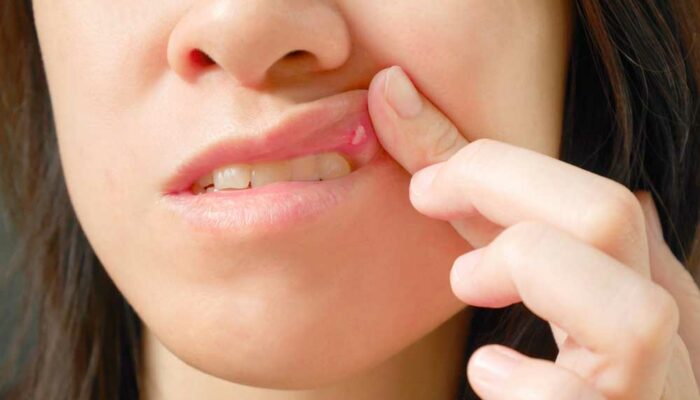 Common Reasons for Sores in the Mouth