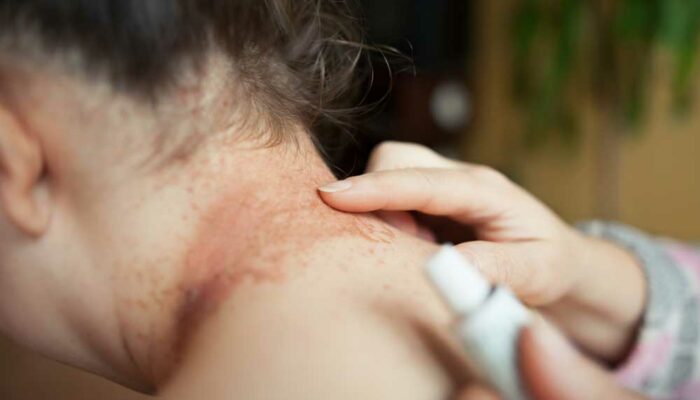 Common Signs and Symptoms of Eczema