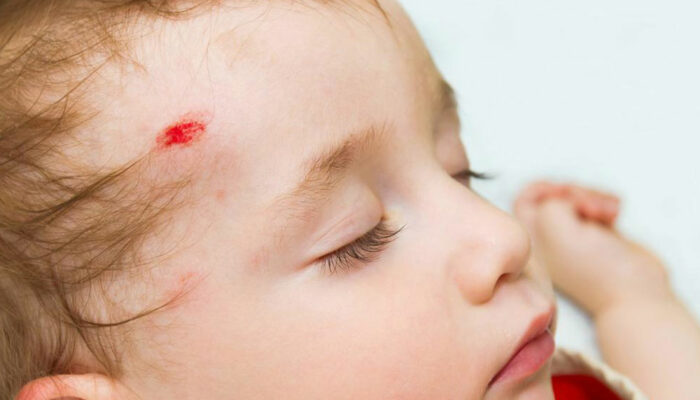 Common head injury symptoms in adults and children