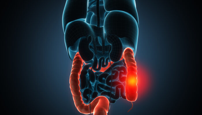 Crohn’s Disease Common Signs and Symptoms