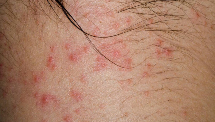 Curious about atopic dermatitis? Here&#8217;s what you need to know