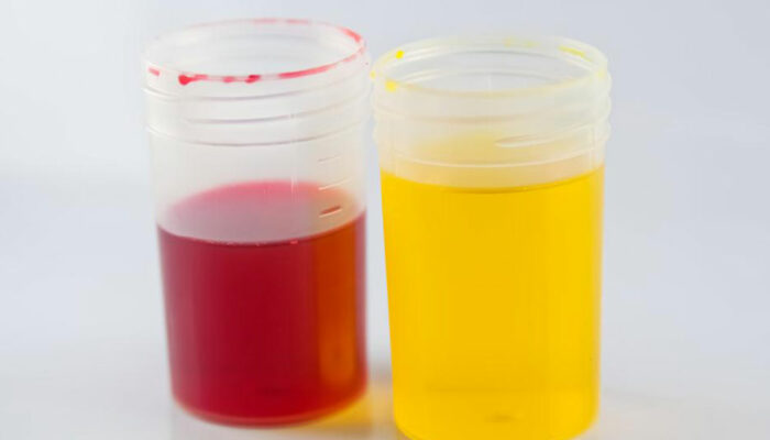 Definition, causes and symptoms of urine color