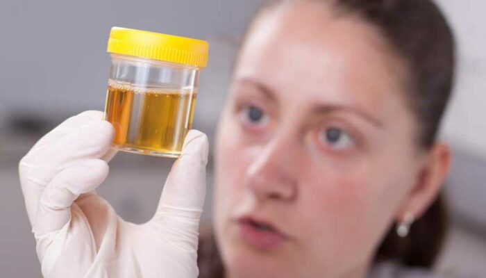 Determining Your Health with a Urine Color Chart