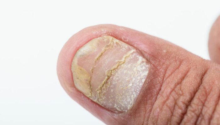 Different types of nail diseases and their causes