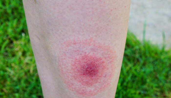 Early signs of lyme disease