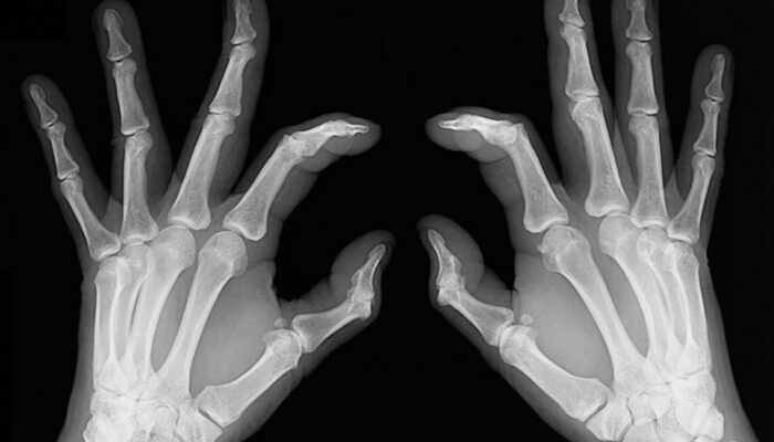 Early signs of rheumatoid arthritis and how to catch them