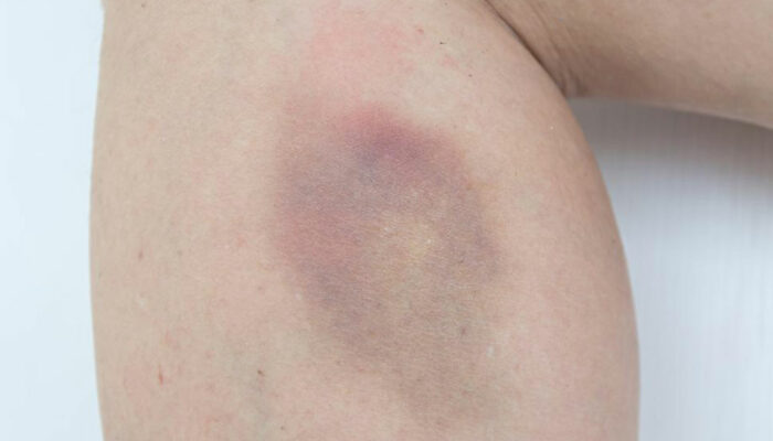 Easy bruising &#8211; Causes and treatments