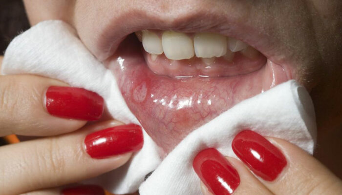 Effective ways to prevent cold sores