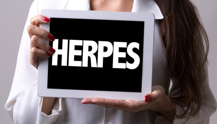 Effective alternative treatments to cure herpes