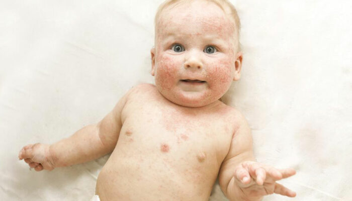 Everything you need to know about atopic dermatitis