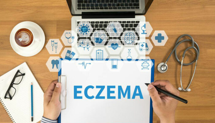 Everything you need to know about eczema