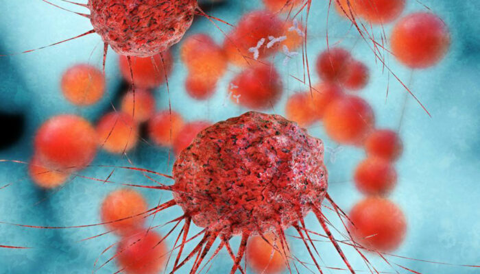 Everything you need to know about metastatic ovarian cancer