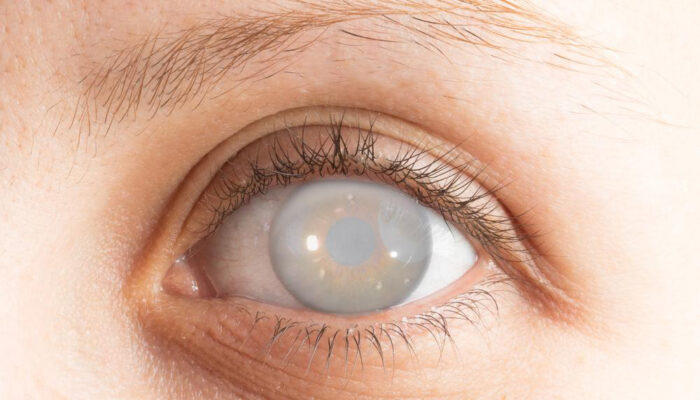 Five facts to know about cataract and its surgery