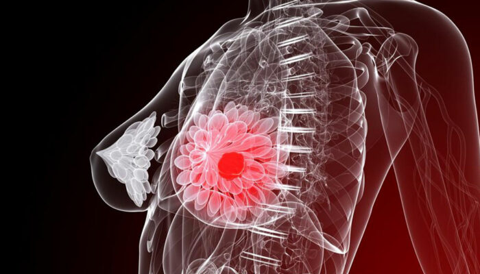 Five things you need to know about breast cancer