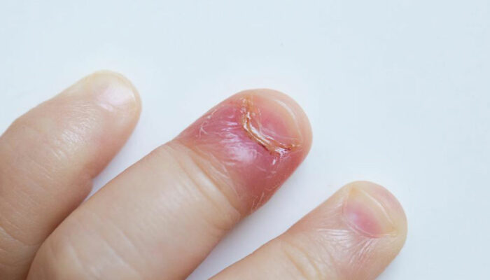 Four reasons for swollen finger pain